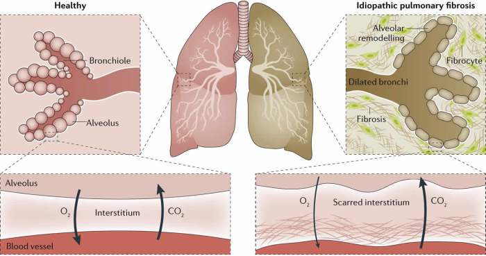 Pulmonary fibrosis symptoms